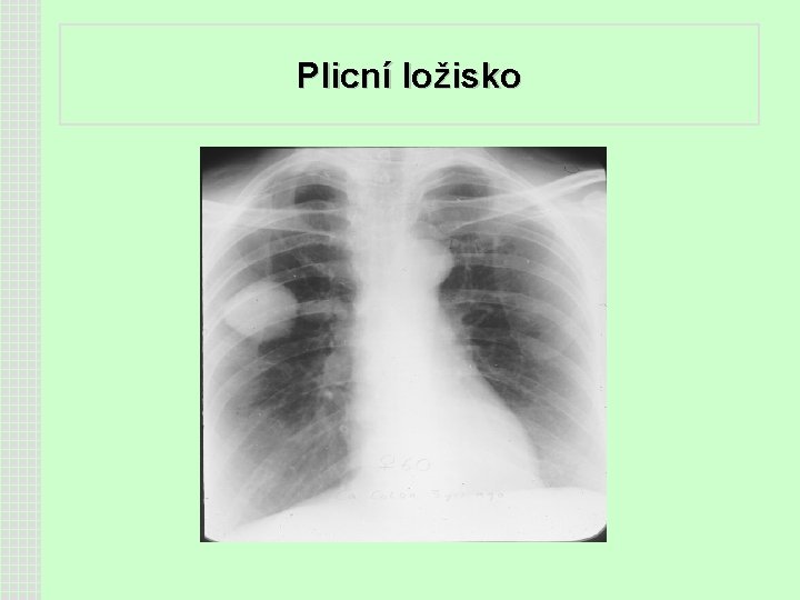 Plicní ložisko 
