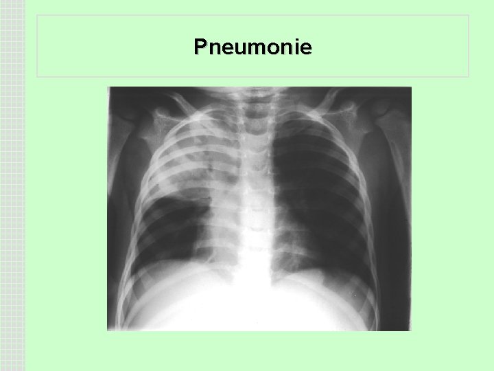 Pneumonie 