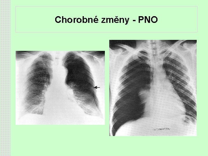 Chorobné změny - PNO 