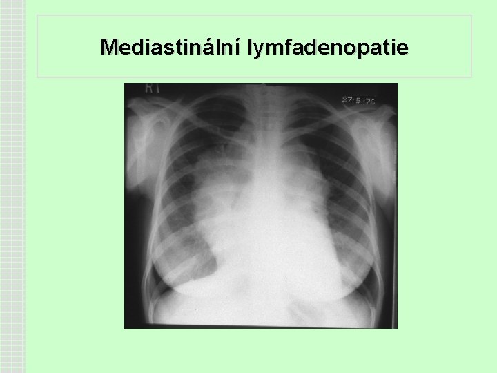 Mediastinální lymfadenopatie 