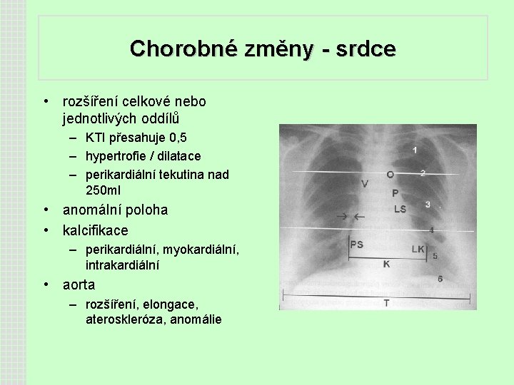 Chorobné změny - srdce • rozšíření celkové nebo jednotlivých oddílů – KTI přesahuje 0,
