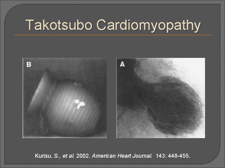 Takotsubo Cardiomyopathy Kurisu, S. , et al. 2002. American Heart Journal. 143: 448 -455.