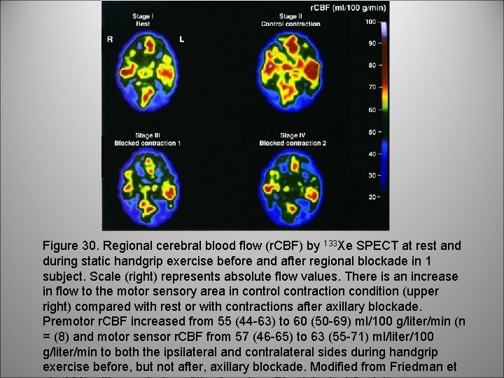 Figure 30. Regional cerebral blood flow (r. CBF) by 133 Xe SPECT at rest