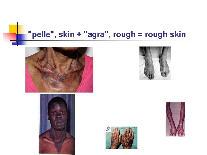 "pelle", skin + "agra", rough = rough skin 