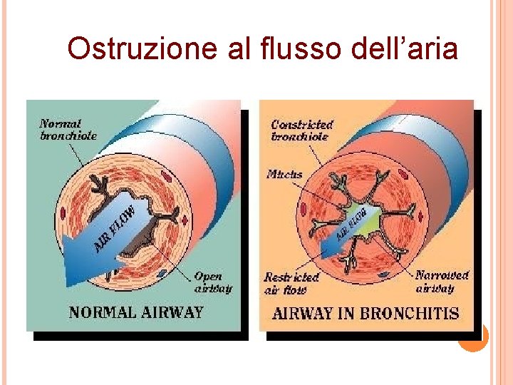 Ostruzione al flusso dell’aria 