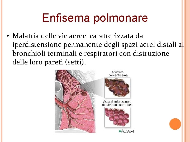 Enfisema polmonare • Malattia delle vie aeree caratterizzata da iperdistensione permanente degli spazi aerei