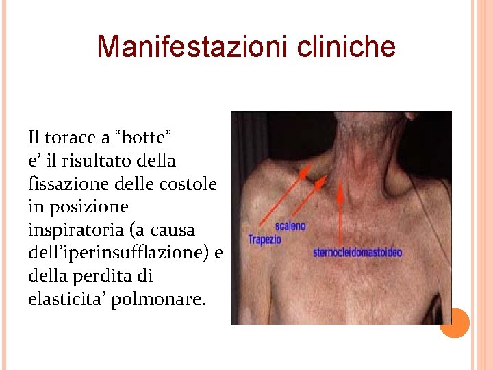 Manifestazioni cliniche Il torace a “botte” e’ il risultato della fissazione delle costole in