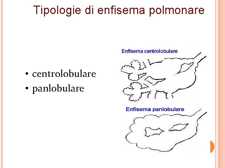 Tipologie di enfisema polmonare • centrolobulare • panlobulare 