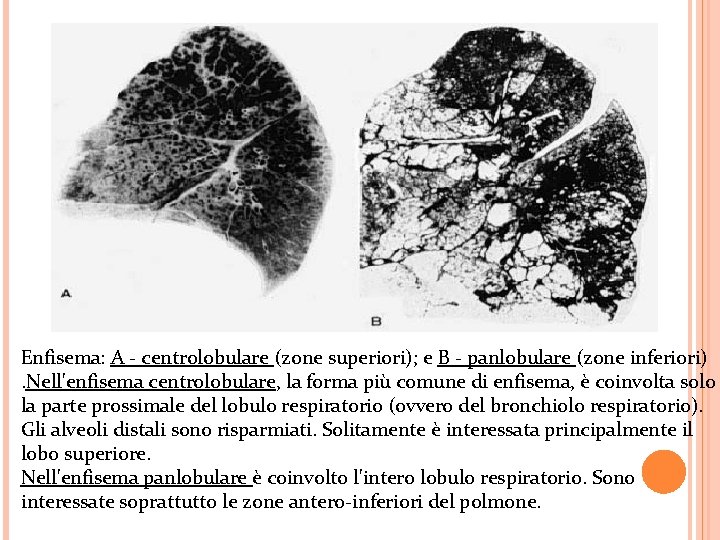 Enfisema: A - centrolobulare (zone superiori); e B - panlobulare (zone inferiori) . Nell'enfisema