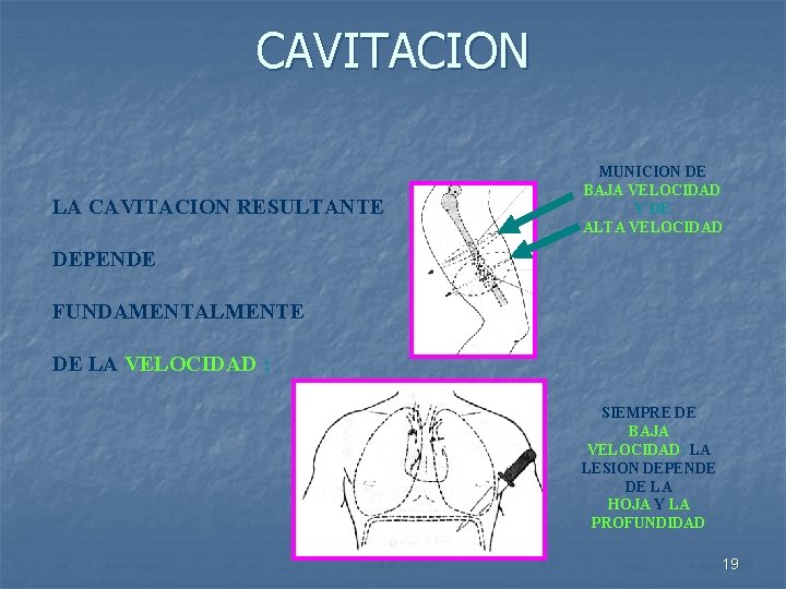 CAVITACION LA CAVITACION RESULTANTE MUNICION DE BAJA VELOCIDAD Y DE ALTA VELOCIDAD DEPENDE FUNDAMENTALMENTE