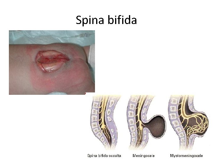 Spina bifida 