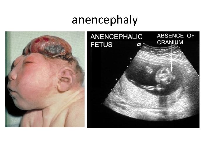 anencephaly 