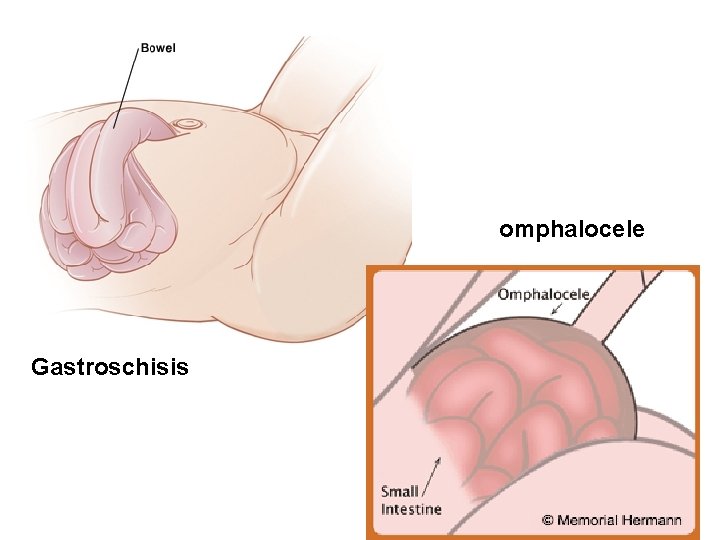 omphalocele Gastroschisis 