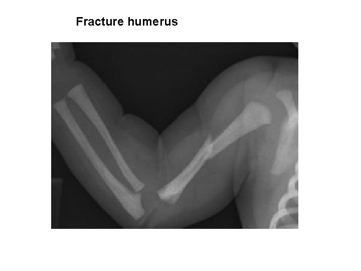 Fracture humerus 