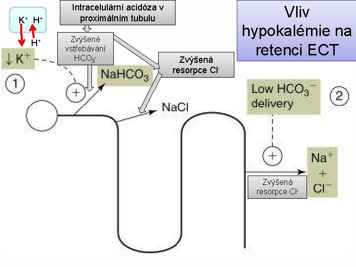 K + H+ H+ Intracelulární acidóza v proximálním tubulu Zvýšené vstřebávání HCO 3 -