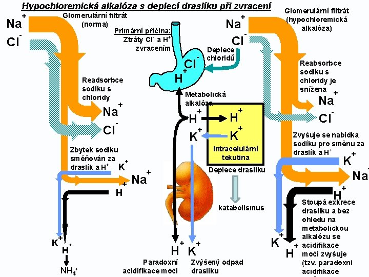 Hypochloremická alkalóza s deplecí draslíku při zvracení Na Cl Glomerulární filtrát (norma) Primární příčina: