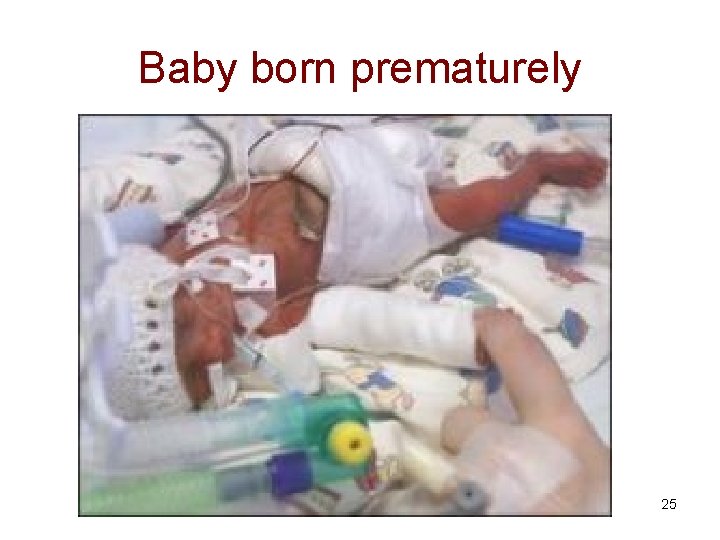 Baby born prematurely 25 