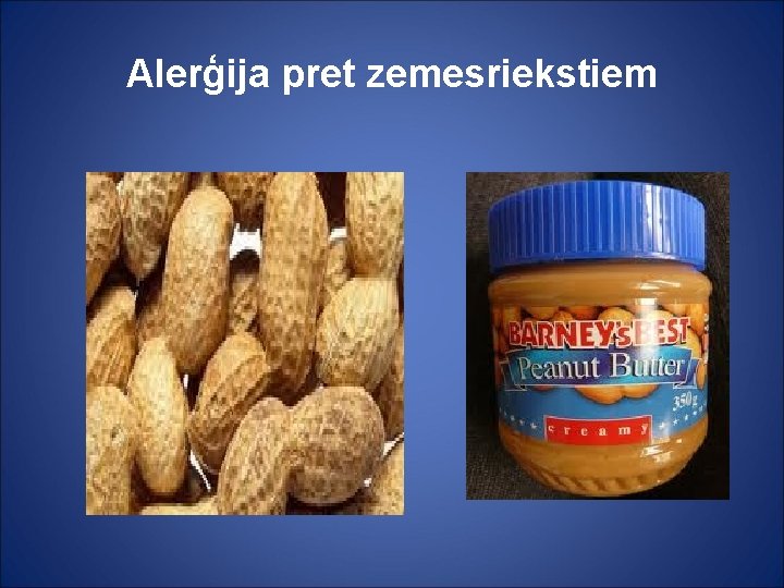 Alerģija pret zemesriekstiem 