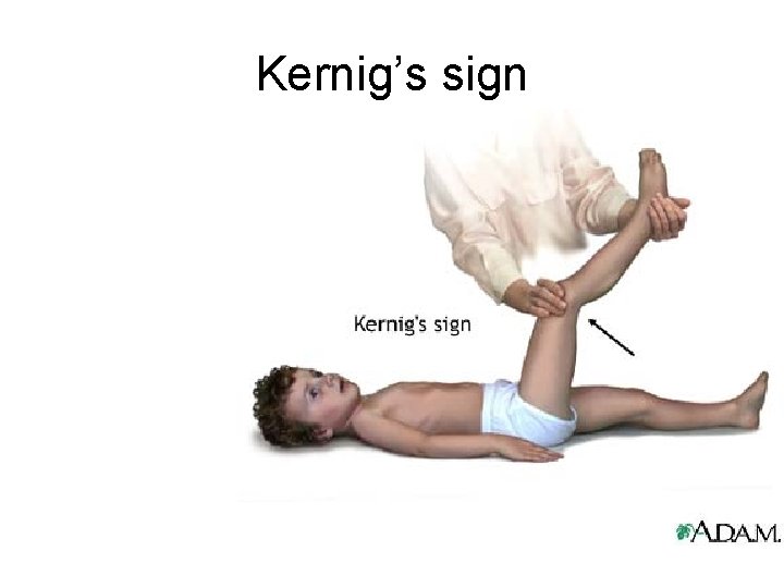 Kernig’s sign 