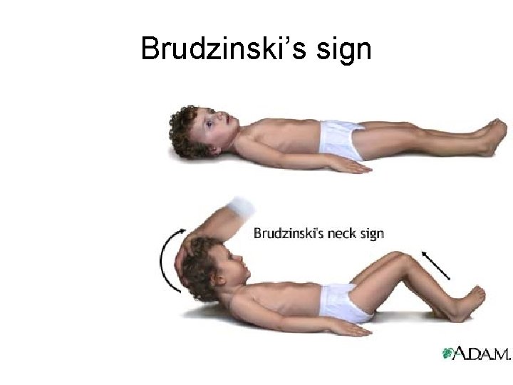 Brudzinski’s sign 