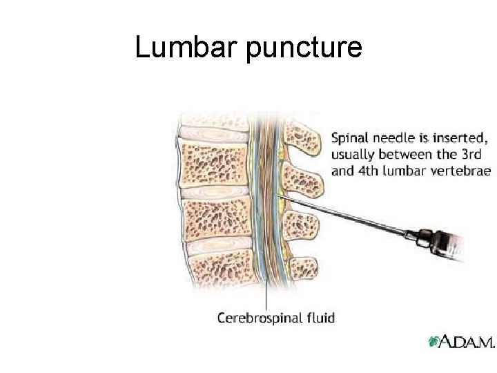 Lumbar puncture 