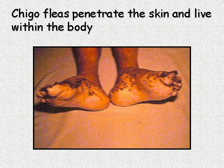 Chigo fleas penetrate the skin and live within the body 