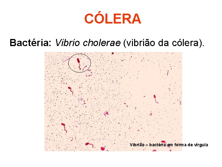 CÓLERA Bactéria: Vibrio cholerae (vibrião da cólera). Vibrião – bactéria em forma de vírgula