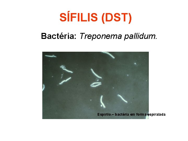 SÍFILIS (DST) Bactéria: Treponema pallidum. Espirilo – bactéria em forma espiralada 