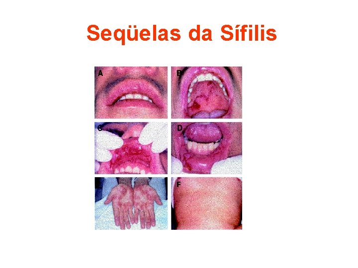Seqüelas da Sífilis 