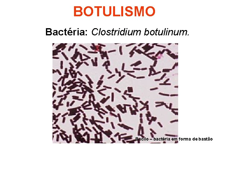 BOTULISMO Bactéria: Clostridium botulinum. Bacilo – bactéria em forma de bastão 