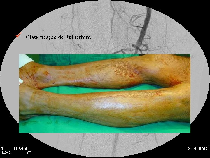 ü Classificação de Rutherford 