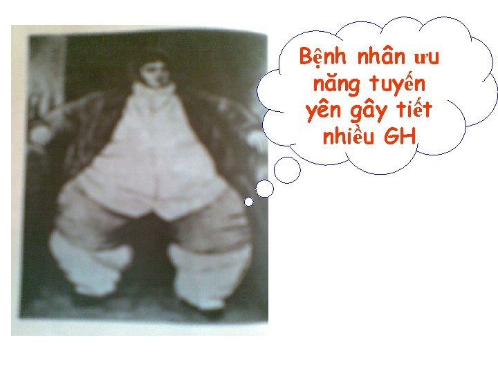 Bệnh nhân ưu năng tuyến yên gây tiết nhiều GH 