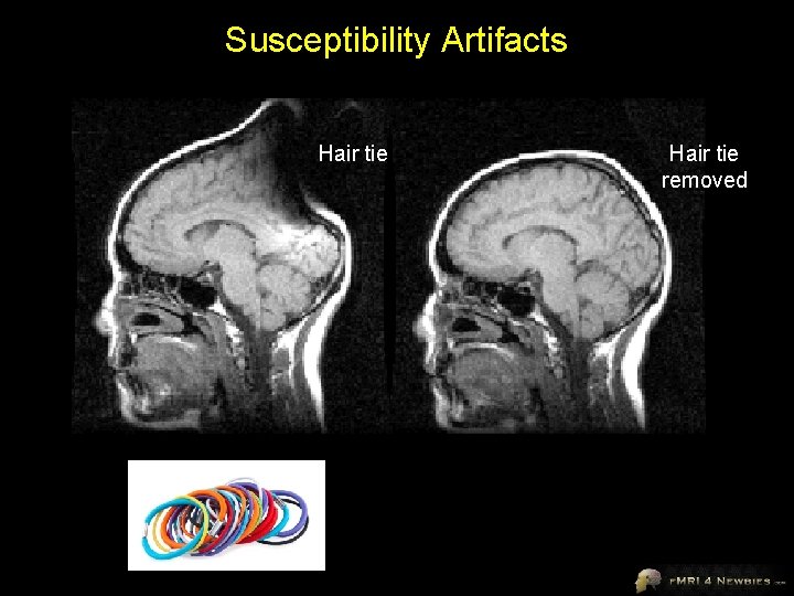 Susceptibility Artifacts Hair tie removed 