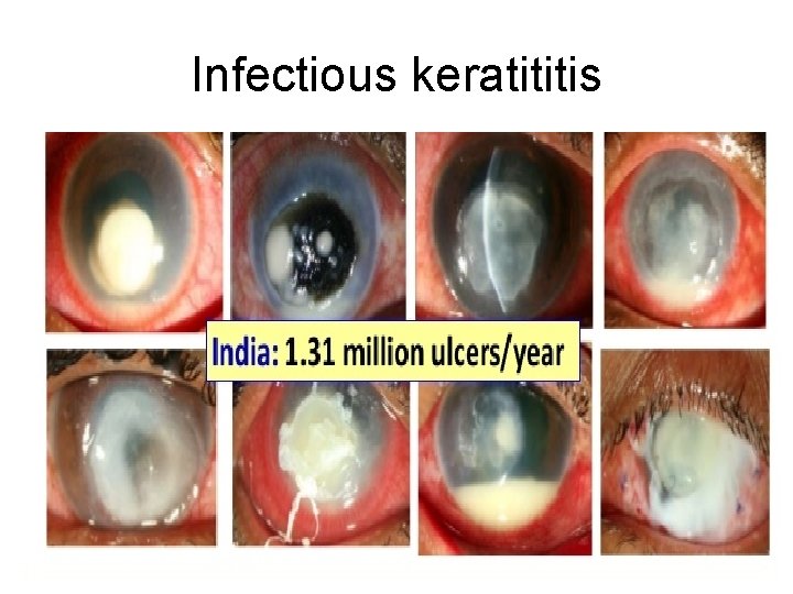 Infectious keratititis 