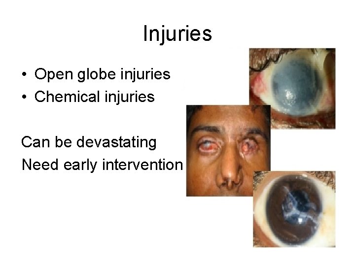 Injuries • Open globe injuries • Chemical injuries Can be devastating Need early intervention