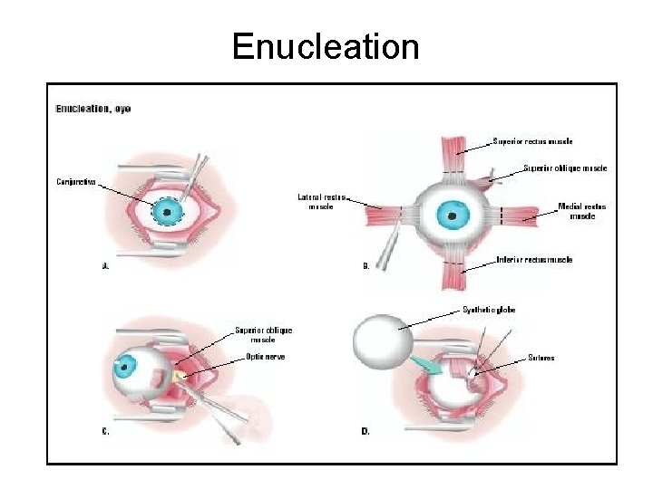 Enucleation 
