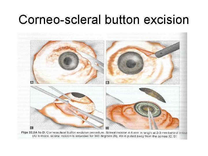 Corneo-scleral button excision 