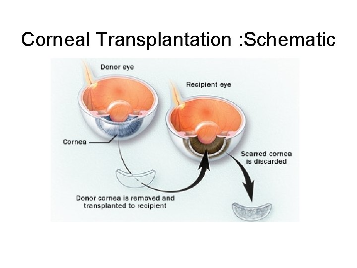 Corneal Transplantation : Schematic 