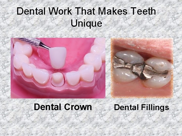 Dental Work That Makes Teeth Unique Dental Crown Dental Fillings 