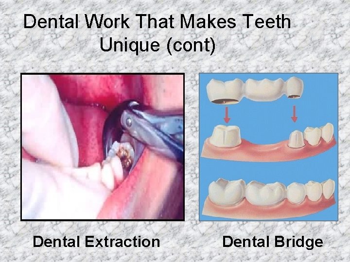 Dental Work That Makes Teeth Unique (cont) Dental Extraction Dental Bridge 