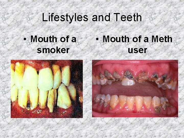 Lifestyles and Teeth • Mouth of a smoker • Mouth of a Meth user