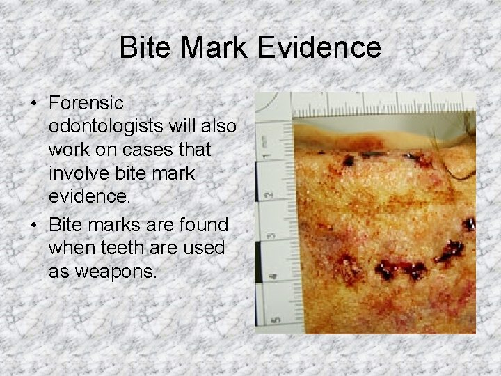 Bite Mark Evidence • Forensic odontologists will also work on cases that involve bite