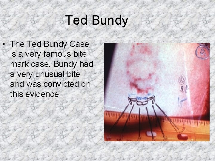 Ted Bundy • The Ted Bundy Case is a very famous bite mark case.