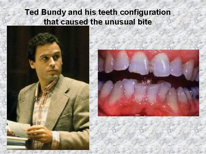 Ted Bundy and his teeth configuration that caused the unusual bite 