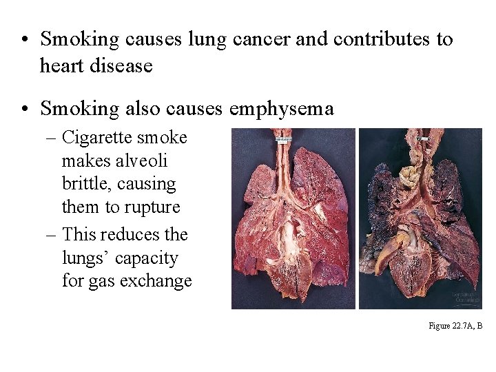  • Smoking causes lung cancer and contributes to heart disease • Smoking also