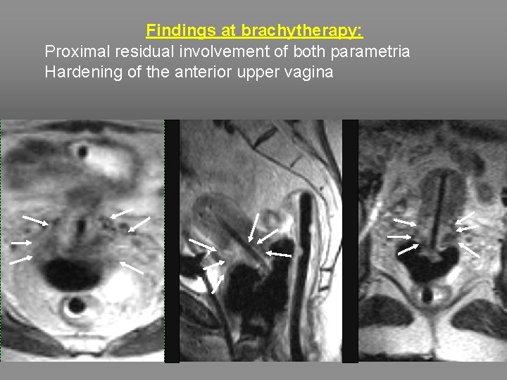 Findings at brachytherapy: Proximal residual involvement of both parametria Hardening of the anterior upper