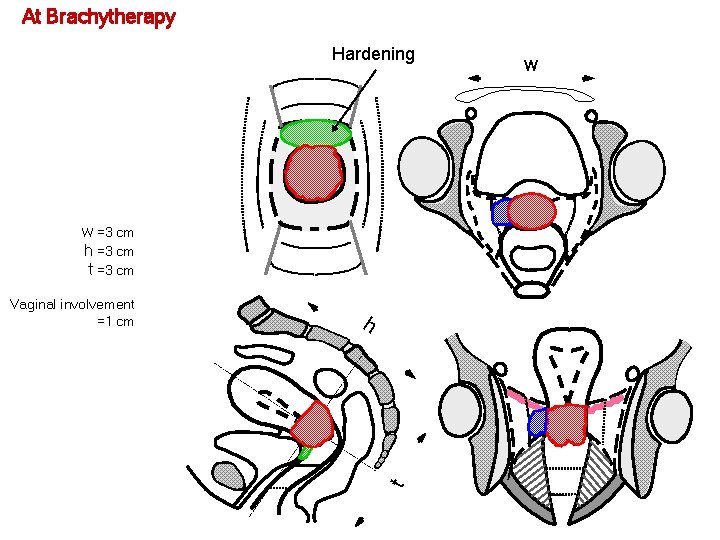 At Brachytherapy Hardening w =3 cm h =3 cm t =3 cm h t