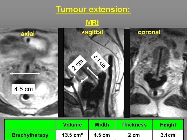 Tumour extension: MRI sagittal axial coronal 2 cm cm 1 3. 4. 5 cm