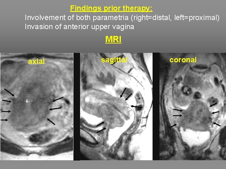 Findings prior therapy: Involvement of both parametria (right=distal, left=proximal) Invasion of anterior upper vagina