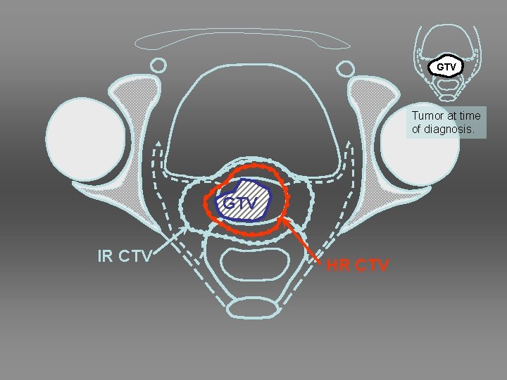 GTV Tumor at time of diagnosis. GTV IR CTV HR CTV 